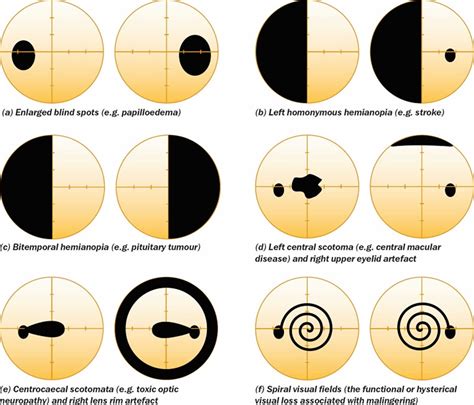 blind spot test normal results